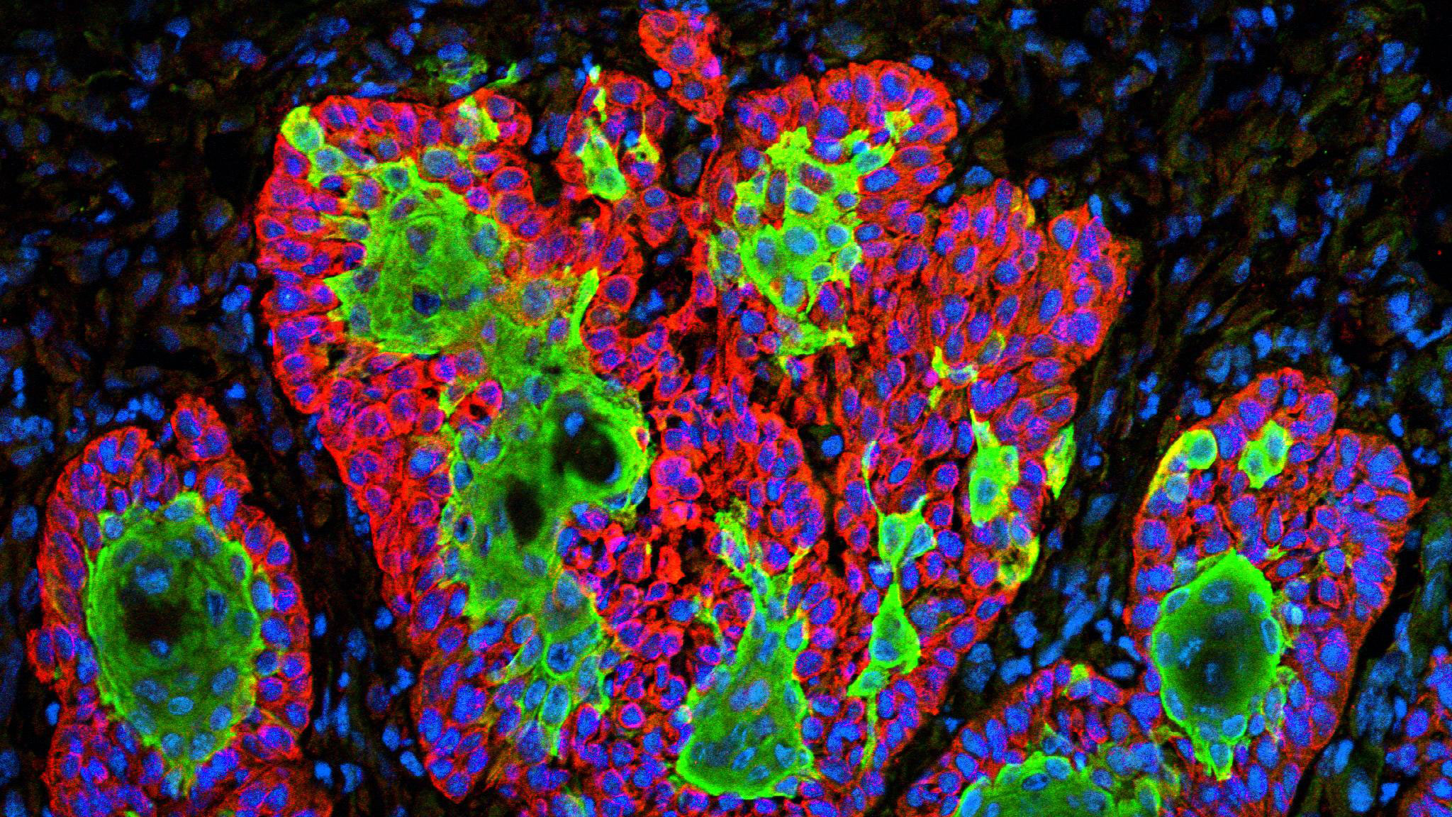 Multi colored image of a squamous cell carcinoma.