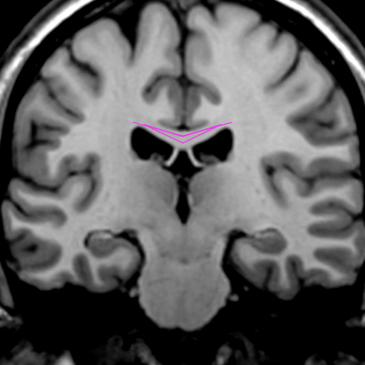 My artistic creation was inspired by diffusion tensor imaging, a method to image fiber tracts in the brain. The program simulates a DTI of the corpus callosum, the largest axon bundle in human brains. The positions of the axons were always random to some degree to reflect the individuality of real brains, and the fibers become thinner at the edges as they separate from each other.