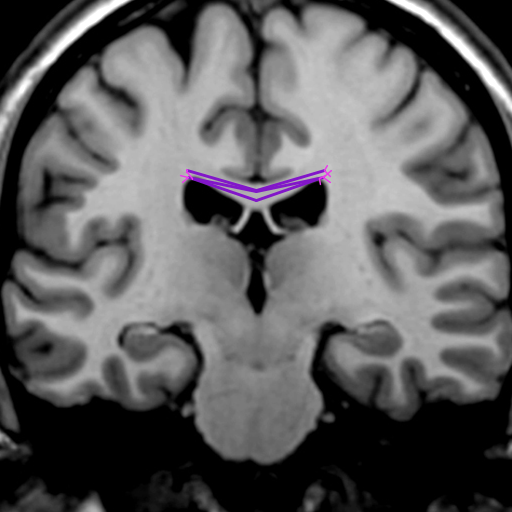 My artistic creation was inspired by diffusion tensor imaging, a method to image fiber tracts in the brain. The program simulates a DTI of the corpus callosum, the largest axon bundle in human brains. The positions of the axons were always random to some degree to reflect the individuality of real brains, and the fibers become thinner at the edges as they separate from each other.