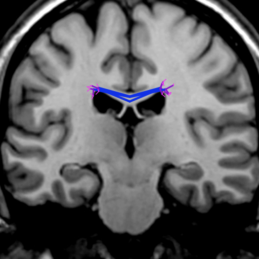 My artistic creation was inspired by diffusion tensor imaging, a method to image fiber tracts in the brain. The program simulates a DTI of the corpus callosum, the largest axon bundle in human brains. The positions of the axons were always random to some degree to reflect the individuality of real brains, and the fibers become thinner at the edges as they separate from each other.