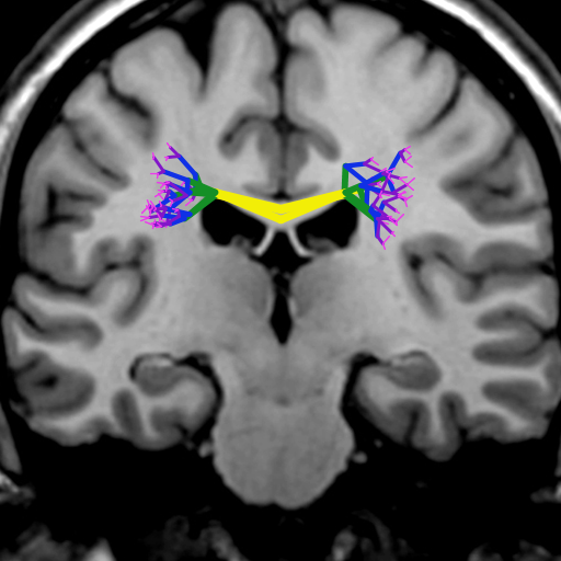 My artistic creation was inspired by diffusion tensor imaging, a method to image fiber tracts in the brain. The program simulates a DTI of the corpus callosum, the largest axon bundle in human brains. The positions of the axons were always random to some degree to reflect the individuality of real brains, and the fibers become thinner at the edges as they separate from each other.