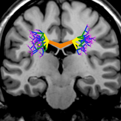 My artistic creation was inspired by diffusion tensor imaging, a method to image fiber tracts in the brain. The program simulates a DTI of the corpus callosum, the largest axon bundle in human brains. The positions of the axons were always random to some degree to reflect the individuality of real brains, and the fibers become thinner at the edges as they separate from each other.