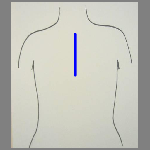 This program was inspired by the images of trees and branches we mentioned in class and that one student created in the fall of 2010 (shown on the assignment page). It creates lungs in the same way a tree might be created, by recursively drawing a line segment with branching points. The output is a series of blood vessicles, randomly colored blue or red, branching off from one another at a random angle within a specified range to give the appearance of lungs. The branching points occur at the end of the vessicle and along it (at the golden ratio).