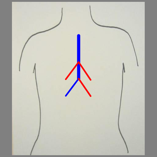 This program was inspired by the images of trees and branches we mentioned in class and that one student created in the fall of 2010 (shown on the assignment page). It creates lungs in the same way a tree might be created, by recursively drawing a line segment with branching points. The output is a series of blood vessicles, randomly colored blue or red, branching off from one another at a random angle within a specified range to give the appearance of lungs. The branching points occur at the end of the vessicle and along it (at the golden ratio).