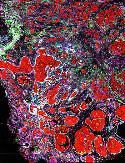 microscopy image of cancer cells